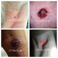 Melanoma timeline. Who knows how long I had it before it was discovered in March 2015?